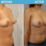 Breast Augmentation Before & After Photo 2018