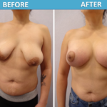 Breast Lift Before & After 2018