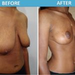Breast Lift Before & After photos