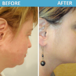 Liposuction - Under Chin-Neck before & after