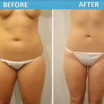 Liposuction Before & After photo 2018