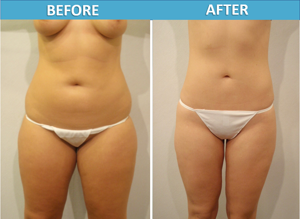 Liposuction Before & After Photos - Center for Cosmetic Surgery in San Diego