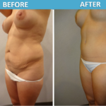 Tummy Tuck Before & After 2018