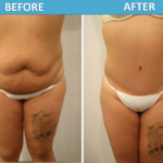 Dr Alavi Tummy Tuck Before & After 2018