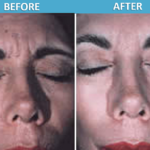 Botox Before & After with Dr. Alavi