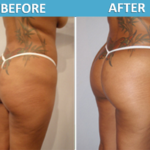 Brazilian Butt Lift by Cosmetic Surgery Center Sassan Alavi MD