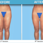 Endermologie Before and after 9 weeks of treatment