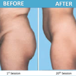 Endermologie Before & After 20 wks of treatment