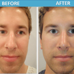 Rhinoplasty Before & After Male photo