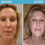 Mini Face Lift Weekend Face Lift Center for Cosmetic Surgery