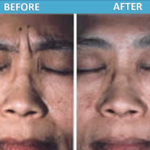 Botox Before and After - Sassan Alavi MD