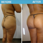 Brazilian Butt Lift before and after photos Sassan Alavi MD