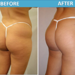 Brazilian Butt lift - Cosmetic Surgery Center San Diego