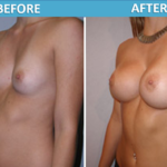 Breast Augmentation Before and After Photos - Sassan Alavi MD