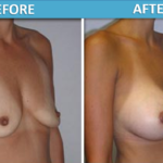 Breast Augmentation Surgery - Sassan Alavi MD