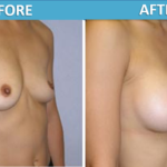 Breast Augmentation Surgery - Sassan Alavi MD