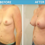 Breast Augmentation Before and After Photos - Sassan Alavi MD