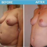Breast Lift Before and After - Sassan Alavi MD
