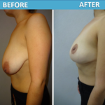 Breast Lift Before and After - Sassan Alavi MD