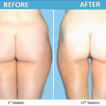 Endermologie Before and After Photos - Sassan Alavi MD