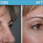Eye or Brow Cosmetic Surgery Before and After Photos - Sassan Alavi MD