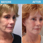 Face Lift Before and After - Sassan Alavi MD