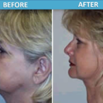 Face Lift Before and After - Sassan Alavi MD