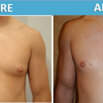 male chest Liposuction and Gyncomastia Surgery before and after | Sassan Alavi MD
