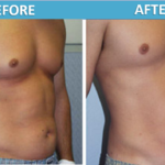 male stomach Liposuction before and after | Sassan Alavi MD