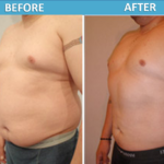 Male stomach Liposuction before and after | Sassan Alavi MD