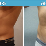 Male stomach Liposuction before and after | Sassan Alavi MD