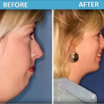 Facial Liposuction before and after | Sassan Alavi MD