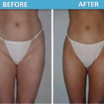 Liposuction before and after | Sassan Alavi MD