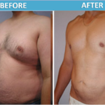 Male stomach and chest Liposuction before and after | Sassan Alavi MD