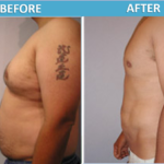 male stomach Liposuction before and after | Sassan Alavi MD