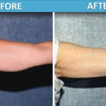 Upper arm Liposuction before and after | Sassan Alavi MD