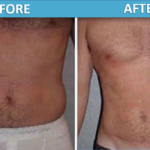 male love handles and stomach Liposuction before and after | Sassan Alavi MD