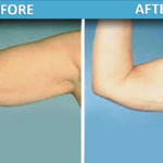 Upper Arm Liposuction before and after | Sassan Alavi MD
