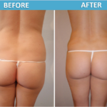 Liposuction before and after | Sassan Alavi MD