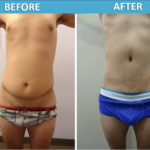 Male Tummy Tuck - front view Cosmetic Surgery Center San Diego
