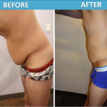 Male Tummy Tuck - side view Cosmetic Surgery Center San Diego