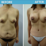 Mommy Makeover Before and After - Sassan Alavi MD