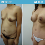 Mommy Makeover Before and After - Sassan Alavi MD