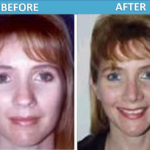 Rhinoplasty Before and After - Sassan Alavi MD