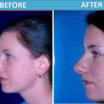 Rhinoplasty Before and After - Sassan Alavi MD