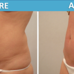 Tummy Tuck Before and After - Sassan Alavi MD