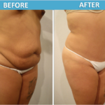 Tummy Tuck Before and After - Sassan Alavi MD