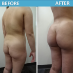 Brazilian Butt Lift before and after photos Sassan Alavi MD