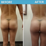 Female Brazilian Butt Lift before and after photos Sassan Alavi MD