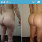 BBL Brazilian Butt Lift before and after photos Sassan Alavi MD